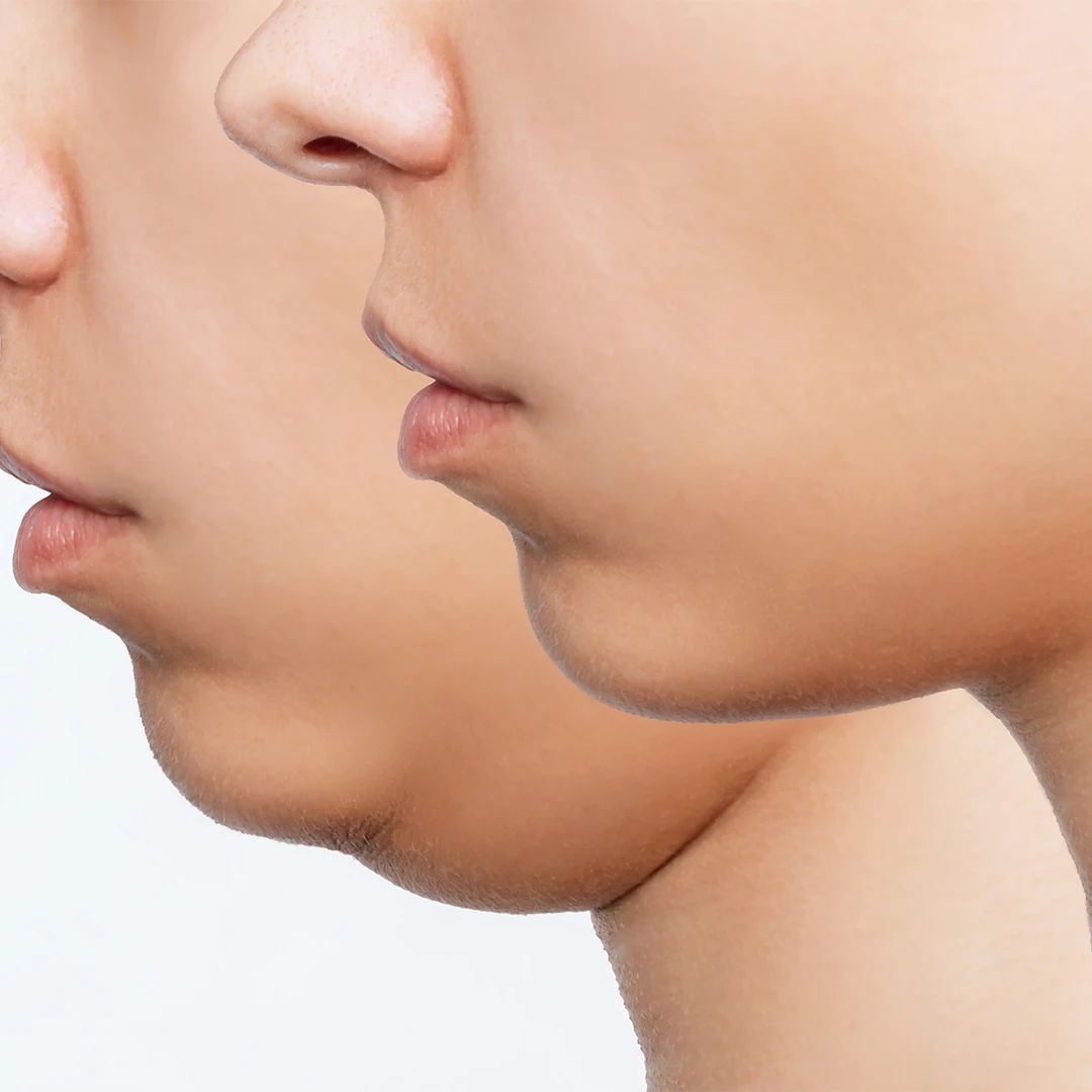Double chin removal Benefits