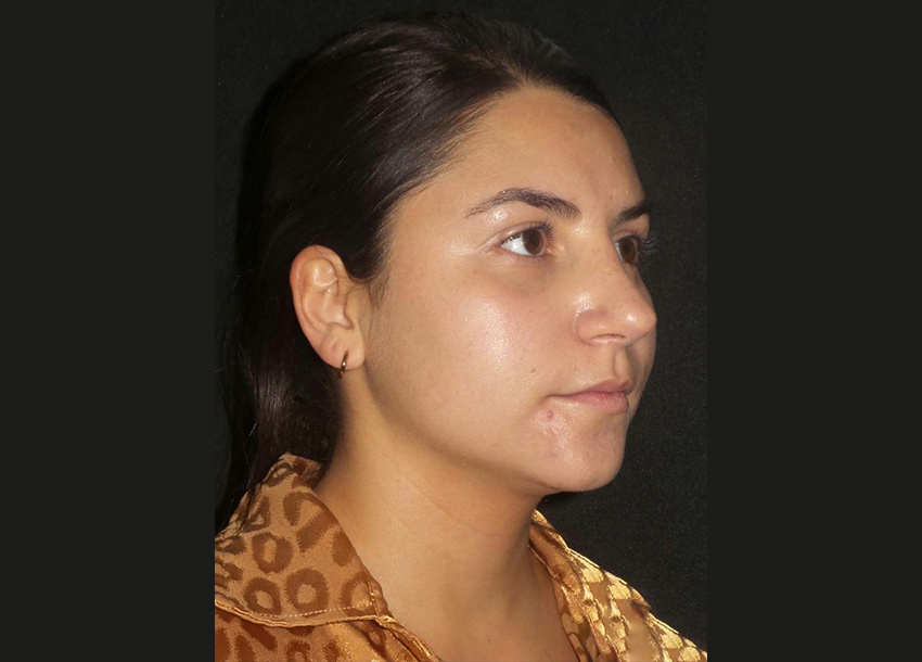 Before Face Fat Reduction Treatment