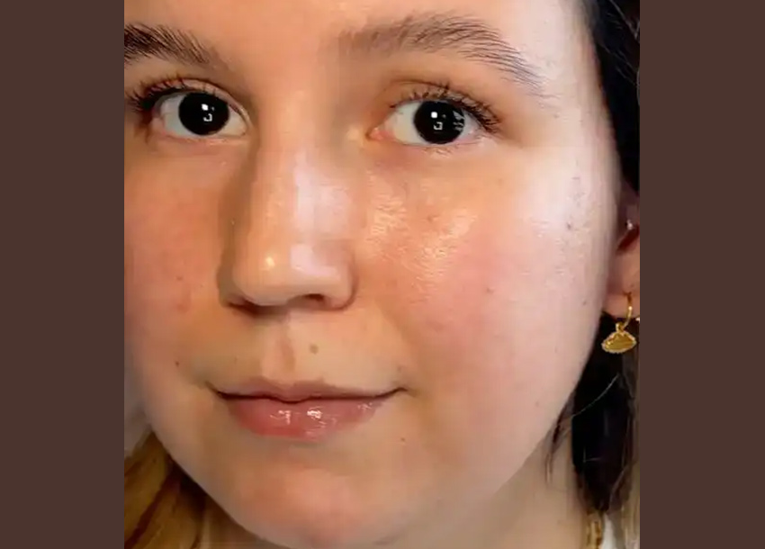 Before Face Fat Reduction Treatment