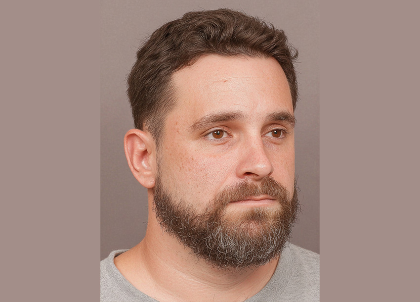 Before Face Fat Reduction Treatment