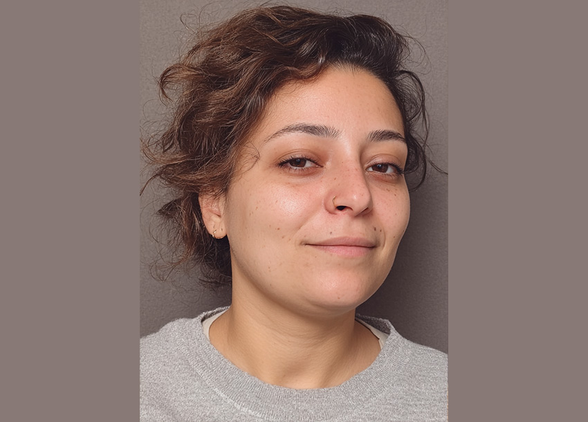Before Face Fat Reduction Treatment