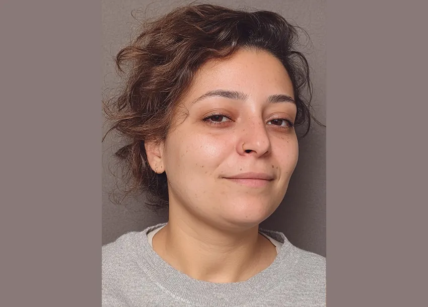 Before Face Fat Reduction Treatment