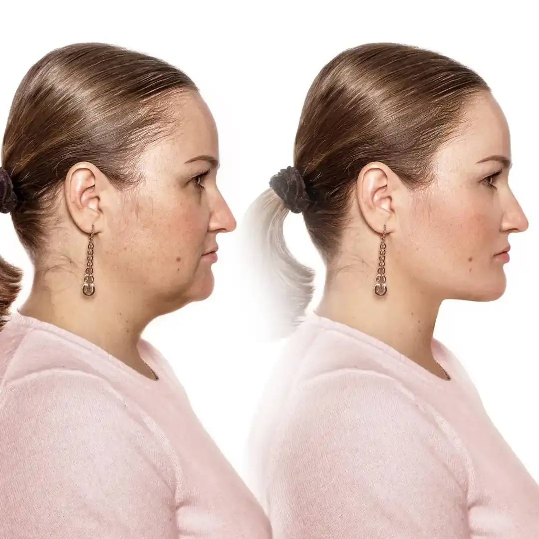 Face Fat Reduce Benefits Section 02