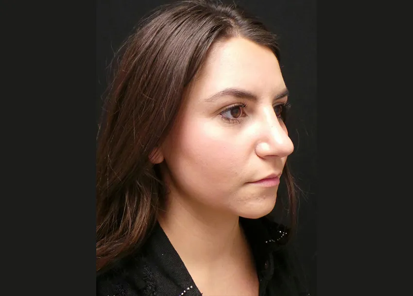 After Face Fat Reduction Treatment