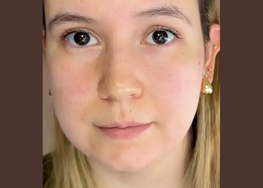 After Face Fat Reduction Treatment