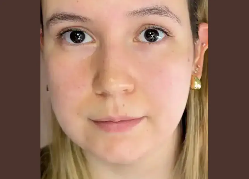 After Face Fat Reduction Treatment