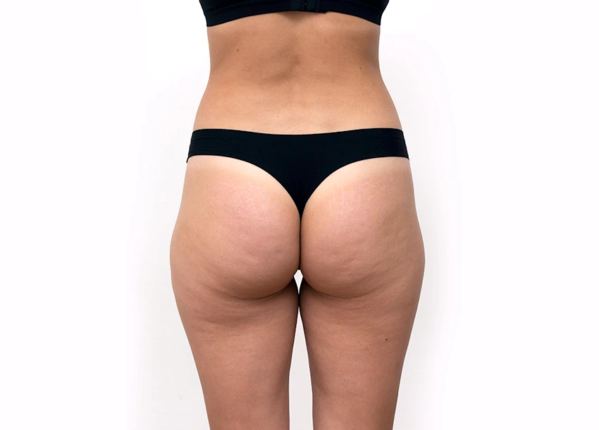 Before Hip Fat Reduction Treatment