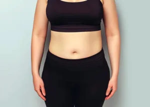 Before Hip Fat Reduction Treatment