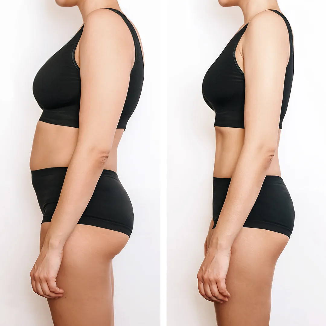 Reduce Hip Fat In Bangladesh