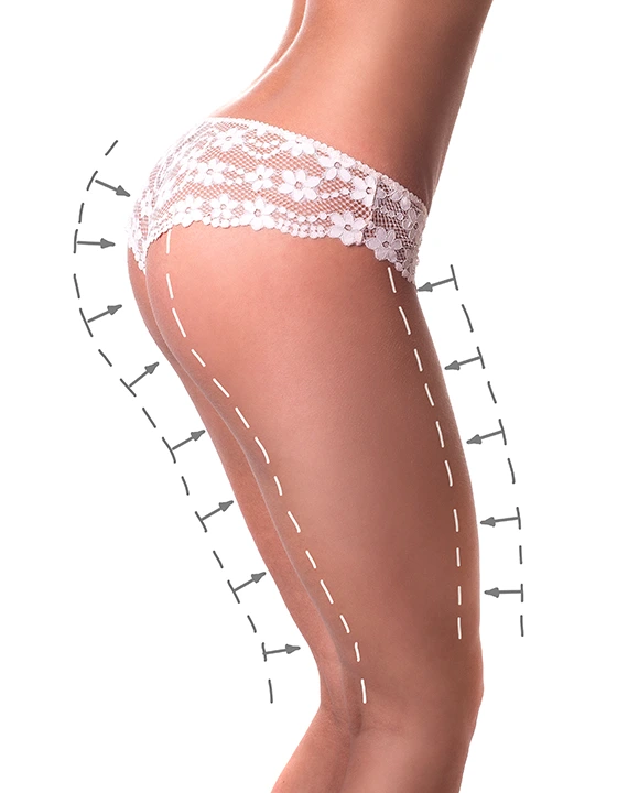 Hip Fat Reduction Treatment