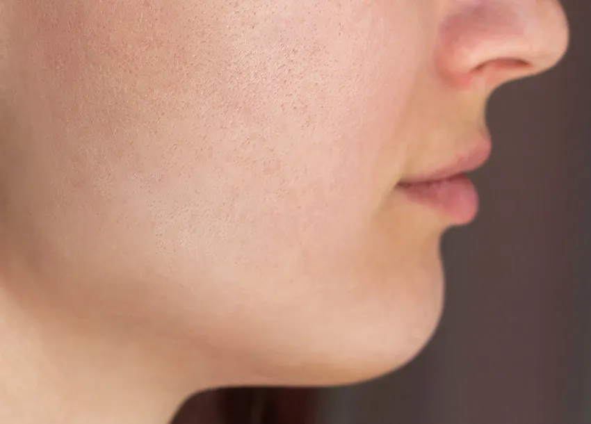 Acne Spot Treatment Impressive Transformation