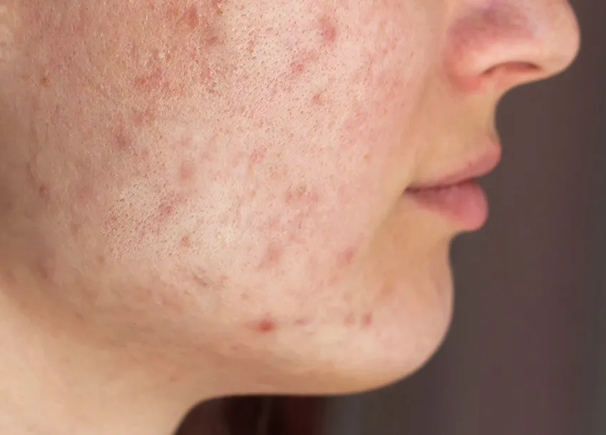 Affordable Acne Scars Removal in Dhaka