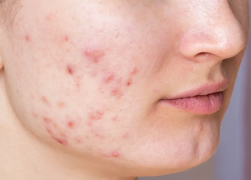 Acne Spot Removal