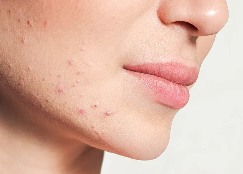 Acne Scars Removal Laser Outstanding Benefits