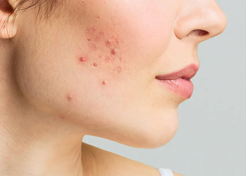 Affordable Treatment for Pimples Spot