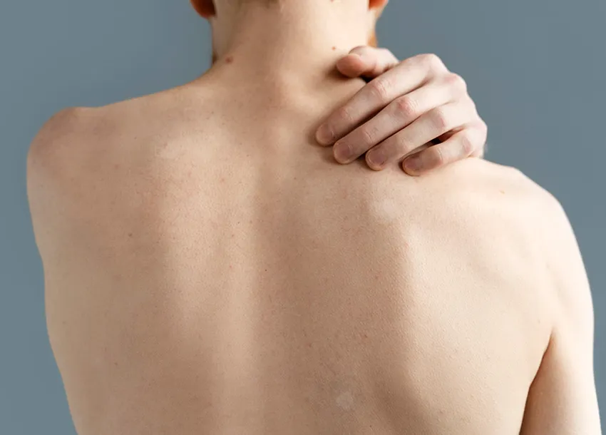Best Freckles Remove Treatment in Dhanmondi Skin and Laser Center