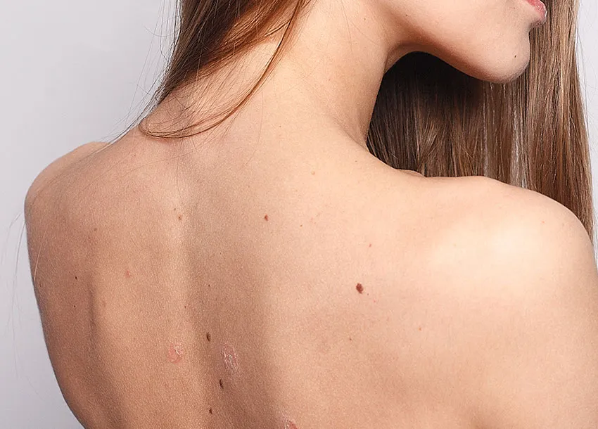 freckles removal: glossy and spotless skin
