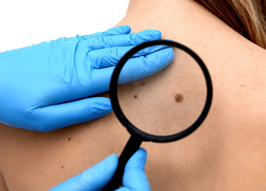 Affordable Mole Remove Treatment in Bangladesh