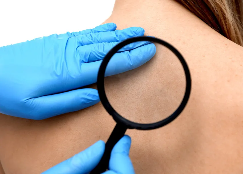 Affordable Achil Remove Treatment At Dhanmondi Skin and Laser Center